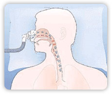 cpap1